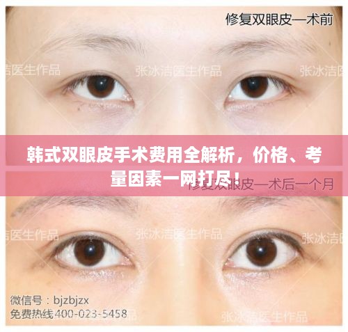 韓式雙眼皮手術(shù)費(fèi)用全解析，價(jià)格、考量因素一網(wǎng)打盡！