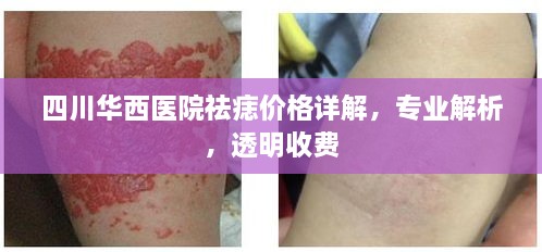 四川華西醫(yī)院祛痣價格詳解，專業(yè)解析，透明收費