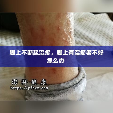 腳上不斷起濕疹，腳上有濕疹老不好怎么辦 