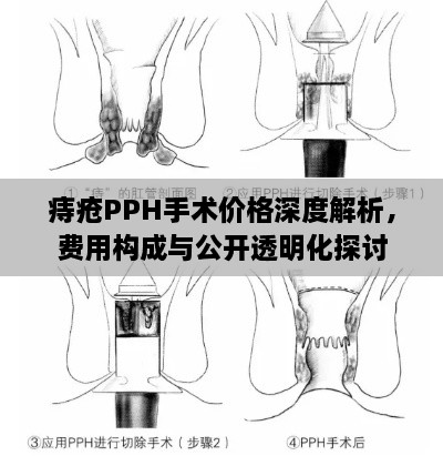 痔瘡PPH手術(shù)價(jià)格深度解析，費(fèi)用構(gòu)成與公開透明化探討