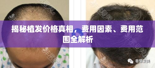 揭秘植發(fā)價(jià)格真相，費(fèi)用因素、費(fèi)用范圍全解析