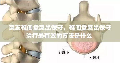 突發(fā)椎間盤突出保守，椎間盤突出保守治療最有效的方法是什么 