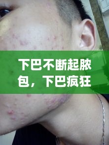 下巴不斷起膿包，下巴瘋狂長膿包 