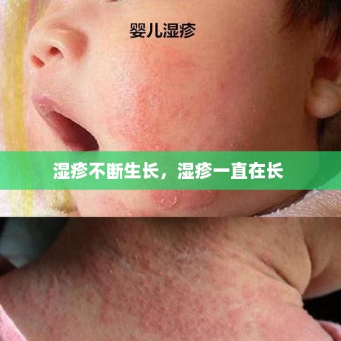濕疹不斷生長，濕疹一直在長 