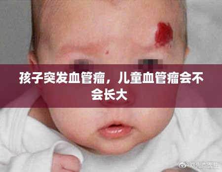 孩子突發(fā)血管瘤，兒童血管瘤會(huì)不會(huì)長大 